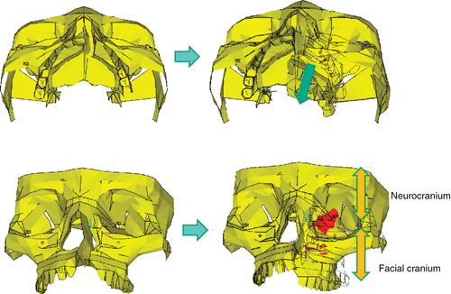 Figure 9.  In patients with cleft palate, the maxilla on the cleft side deviates in the posterior direction when impacts are applied (from left column to right column). The orbital walls constitute a junction between the facial cranium and the neurocranium (right below). Intensified stresses therefore occur on the orbital walls as the maxilla on the cleft side moves posteriorly (red regions).