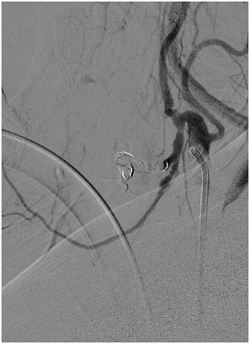Figure 3. DSA of the left external carotid artery showing successful embolization of the facial artery pseudoaneurysm with cessation of hemorrhage.
