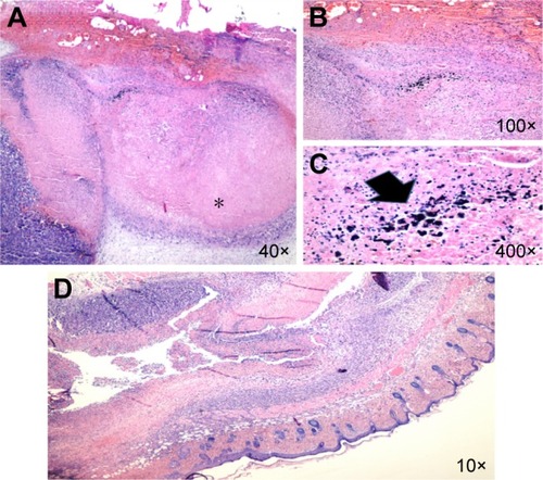 Figure 8 Malignant melanoma.Notes: (A) (*) Histopathologic section of the laser therapy case which shows the zone of tumor necrosis (H&E). (B, C) There is the deposition of NPs (arrow) in O-CNT-PEG group within the necrotic areas (H&E). (D) Histopathologic section of the tumor in the case allocated to the O-CNT-PEG group which shows high percent of tumor necrosis (10×; (H&E)).Abbreviations: H&E, hematoxylin and eosin; NPs, nanoparticles; O-CNT, oxidized carbon nanotube; PEG, polyethylene glycol.