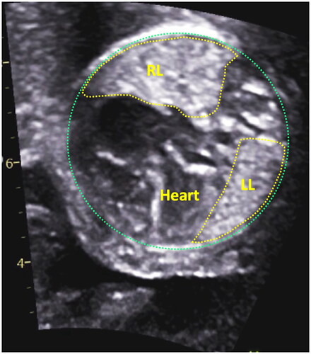 Figure 1. Two-dimensional ultrasound axial view of the fetal chest at four-chambers level showing the area tracing measurements of the fetal right lung (RL) and fetal left lung (LL).