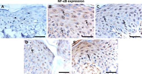 Figure 5 Effect of Leiurus quinquestriatus venom extract on NF-κB expression in chemically induced skin tumors.