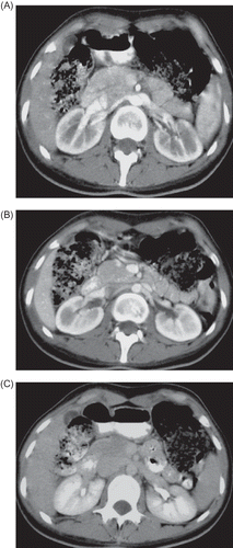 Figure 2. (A)–(C) Following the anticoagulant treatment, a control triphasic CT examination was performed. In this examination, the focal cortical perfusion defect disappeared completely and both the kidneys were reported as completely normal.