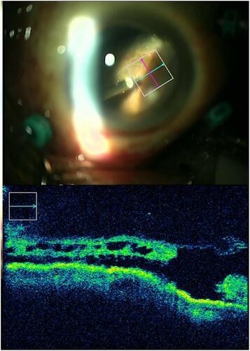 Figure 1 Peripheral cystoid degeneration around retinal break assessed by intraoperative optical coherence tomography (a 71-year-old-male).