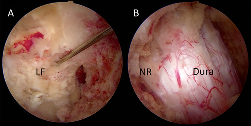 Figure 1 (A) Ropivacaine is injected into the epidural space using a spinal needle. (B) Dural sac and nerve root after decompression. LF, ligamentum flavum; NR, nerve root.