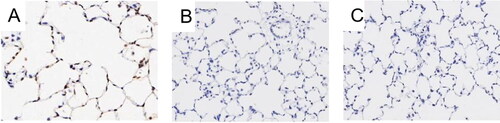 Figure 3. Apoptosis of alveolar septal cells in rat lungs. Notes: Apoptosis of alveolar septal cells in rat lungs was detected by immunohistochemistry. (A) Rats receiving CD4 + T cells hypomethylated, adjuvant and PBS; (B) Control rats receiving normal CD4 + T cells, adjuvant and PBS; (C) Rats receiving adjuvant and PBS. Data presented were one representative image data. Magnification: 400×. PBS, phosphate buffered saline.