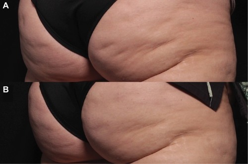 Figure 3 Significant improvement in cellulite of the buttocks 3 months following a single session of vacuum-assisted subcision (B) compared with baseline (A).Source: Photo courtesy of Douglas C. Wu, MD, PhD.