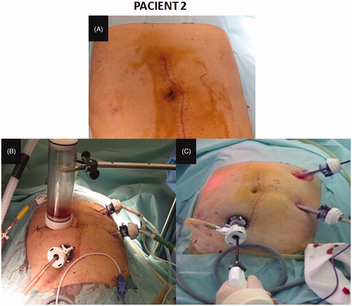 Figure 4. Closed-abdomen laparoscopic HIPEC by CO2 recirculation. Patient 2. A: before surgery; B: during laparoscopic HIPEC; C: during cytoreductive laparoscopic surgery.