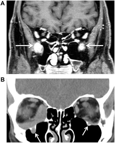 Figure 2 (A) Apparent bilateral infraorbital canal and nerve infiltration (arrows) in a patient with IgG4-ROD (coronary T1 MRI scan with contrast agent). (B) In comparison bilateral infraorbital nerve infiltration (arrows) in a patient with mantle cell OAL (coronary CT scan with contrast agent, soft tissue window).