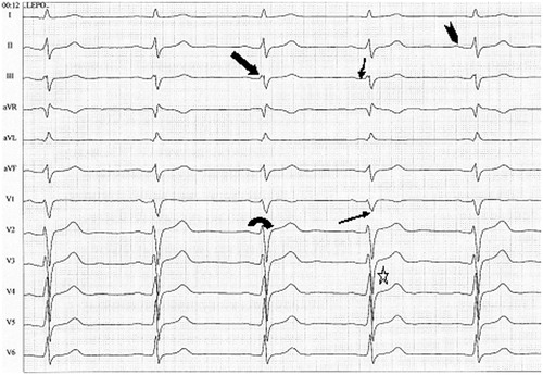 Figure 2. A typical 12-lead ECG in an asymptomatic patient with the SCN5A D1275N mutation. Wide arrow: low amplitude signal at the beginning QRS complex. Narrow arrow: notch in S wave. Display full size: deep S wave in chest leads. Display full size: prolonged S-wave upstroke ≥55 ms. Display full size: flat P wave. Display full size: PR depression.