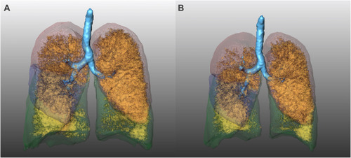 Figure 1 Coronal 3D surface views of the lungs of a 79-year-old female smoker with COPD GOLD 3 (A, B). These surface views were generated with the MeVis PULMO3D software by processing CT scans acquired at full inspiration (A) and full expiration (B). Lung lobes are depicted semitransparent green (lower lobes), red (upper lobes) and blue (right middle lobe). Emphysematous lung parenchyma, demonstrated as a LAV (i.e., voxels with a density ≤ −950 HU), is depicted in orange and yellow. In this patient, LAV in the right upper lobe significantly decreased in expiration, while LAV in the left upper lobe did not show a significant change between the two respiratory phases.