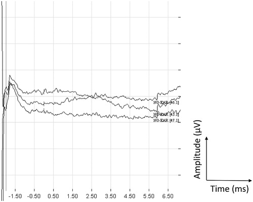 Figure 3. eABR-measurements from stimulating electrode 2 at the Med-El Synchrony ABI. Stimulation at 48 qu in positive, negative and alternating stimulation modes.