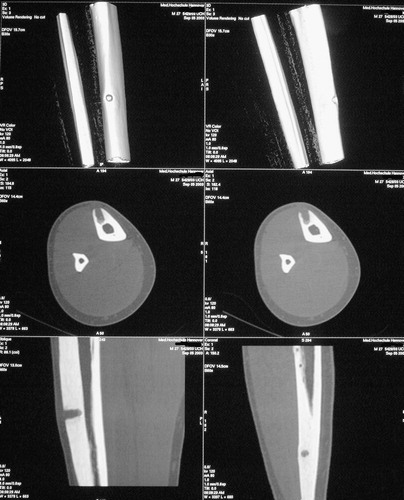 Figure 8. A conventional postoperative CT scan done 5 weeks after surgery on the patient with the distal tibial shaft lesion. The scan is congruent with the direct intraoperative images of the Iso-C3D® control scan (Figure 9).