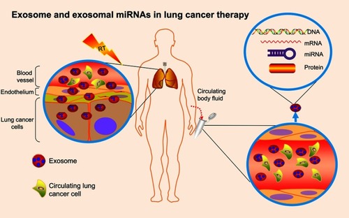 Figure 3 Exosomes and exosomal miRNAs in lung cancer therapy.Notes: Exosomes are small membrane–derived vesicles in circulating body fluids that are released by multiple cell types, including tumor cells and normal cells. Exosomes specialize in intracellular communication, via transporting diverse molecular constitutes. Exosomal cargoes are mainly small regulatory molecules, including miRNAs, mRNAs, DNA, and proteins. Among them, exosomal miRNAs may be promising in regulating cellular radiosensitivity and monitoring radiotherapy effectiveness.