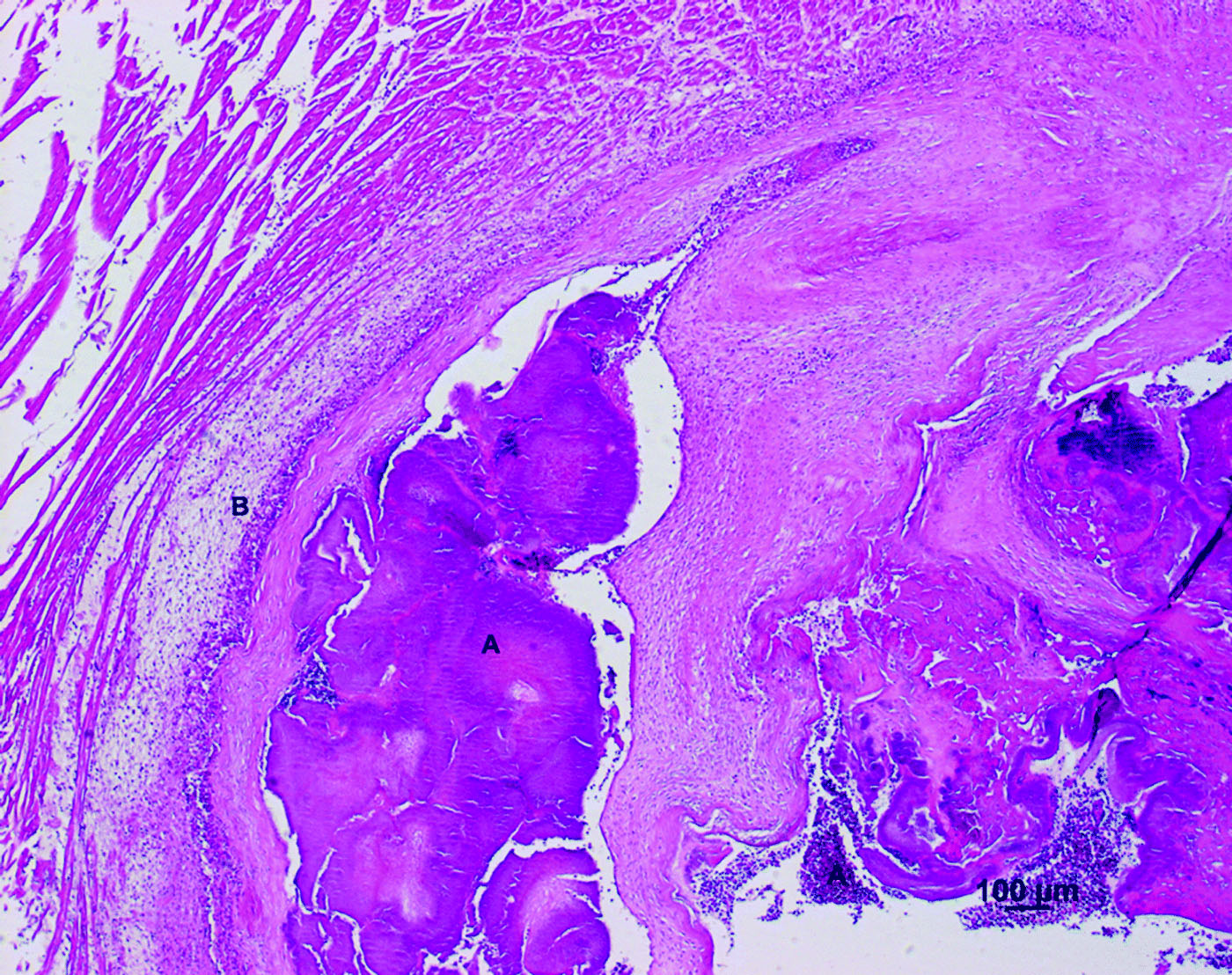 Figure 1.  Cross-section of the valvular region of the right ventricle of an Amazon parrot (A. autumnalis salvini) (haematoxylin and eosin stain). Note heterophils (B) infiltrating the thickened encocardium and bacterial colonization (A) throughout the heart lumen.
