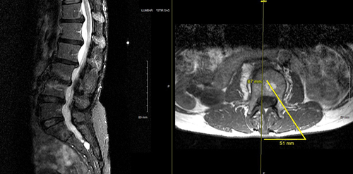 Figure 15 On the left, note the Modic changes at L3/4 on short tau inversion recovery (STIR) MRI. On the right, the first line starts in the vertebral body, passing the anteromedial pedicle, going through the posterolateral pedicle and terminating at the skin. The measurement from the spinous process to the terminus of the first line gives the best starting position for entry into the pedicle.
