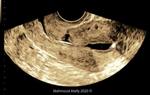 Figure 7 3D SHG image of the uterus showing the cesarean scar niche BW.
