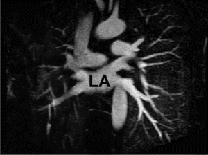 Figure 1. A subtracted 2D slice from 3D-MRA showing 4 pulmonary veins & left atrium (LA).