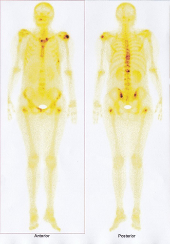 Figure 3 Bone scan: multiple bone metastases.