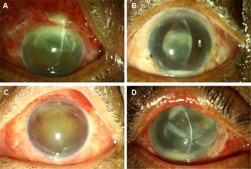 Figure 2 Preoperative clinical photographs of a few exogenous filamentous fungal endophthalmitis cases.