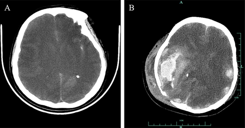 Figure 1 Brain CT images of the patient. (A) Brain CT imaging on October 15, 2019. The head CT imaging was showed diffuse edema of brain tissue, gray matter and white matter structure blurred. (B) Brain CT on September 14, 2022. The brain CT imaging was showed the right temporo-parietal cerebral hemorrhage and occipital defect with subcutaneous abscess.