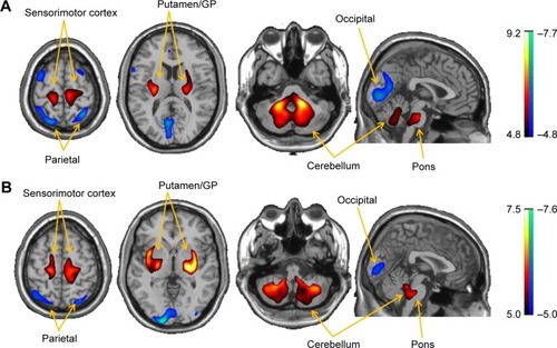 Figure 1 Brain regions with significant metabolic abnormalities in PD patients relative to normal subjects detected by two-sample t-test analysis of 18F-FDG PET scans with SPM in Chongqing and Shanghai cohorts, respectively. (A) Metabolism in PD patients from the Chongqing cohort was characterized by metabolic increases in the putamen, GP, thalamus, pons, sensorimotor cortex and cerebellum (red), along with metabolic decreases in parieto-occipital areas (blue). (B) Metabolism in PD patients from the Shanghai cohort was similarly characterized by metabolic increases in the putamen, GP, thalamus, pons, sensorimotor cortex and cerebellum (red), covarying with metabolic decreases in parieto-occipital areas (blue). The overlays are depicted in neurological orientation. Thresholds of the color bars represent Z values.