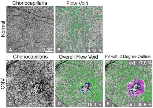 Figure 1 An example of flow void analysis of a swept-source optical coherence tomography (SS-OCT) angiogram from an age-similar normal control (A-B) and choroidal neovascularization (CNV) subject (C-E). (A) Compensated flow choriocapillaris image; (B) Choriocapillaris flow void, or flow lower than 1 standard deviation below the normal mean, is shown as green pixels, accounting for 9.42% of the scanned area; (C) Compensated flow choriocapillaris image; (D) Percent flow void excluding CNV (outlined in blue) and drusen regions (green color represents flow voids; orange color adjacent to CNV represents excluded drusen regions); (E) Percent flow void inside and outside the two-degree margin immediately bordering the CNV lesion. Corresponding flow void percentages for the two-degree margin and remaining scanned area are included (pink color represents flow voids inside the two-degree margin, orange represents drusen, and green color represents flow voids outside of the two-degree margin). Ext. and int. represent outside and inside of the two-degree bordering region, respectively.