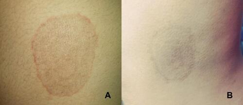 Figure 3 Clinical improvement in CITZ group: (A) before CITZ and (B) after CITZ treatment.