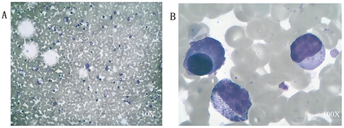 Figure 1 At the time of the MM diagnosis, the bone marrow was as above. (A) x10 magnification; (B) x100 magnification.
