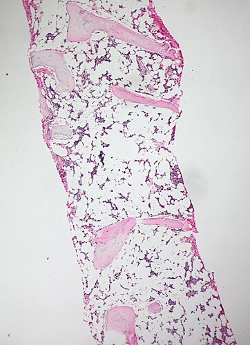 Figure 1. Trephine biopsy showing bone marrow aplasia. Hematoxylin and Eosin stain. Magnification ×100.