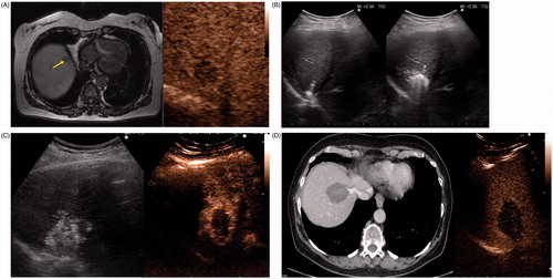 Figure 2. A 67-year-old woman with liver metastasis from colorectal cancer. (A) Pre-ablation MRI (left) of liver lesion (arrow) and CEUS (right) confirming presence of 13 × 14 mm liver lesion (arrow). (B) The lesion was treated with a single water-cooled antenna at 50 W for 6 min (left). Post-ablation image demonstrating hyper-echoic region measuring 34 × 37 mm, representing the ablation zone (right). The goal is to create ablation margins >1 cm beyond tumour boundary. (C) Post-ablation B-mode ultrasound (left) and CEUS (right) showing the ablation zone (anechoic) with the presence of the hypervascular peri-lesional halo. (D) CECT (left) and CEUS (right) demonstrating ablation zones that encompass the entire lesion measuring 32 × 42 mm.