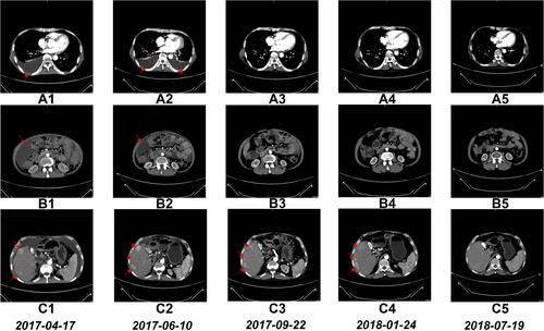Figure 8 CT scan findings before and during the treatment with NK cells. CT scans showing complete disappearance of pleural effusion after 6 courses of treatment (A1–A5). CT scans showing almost complete disappearance of ascites after 6 courses of treatment (B1–B5). CT scans showing the sizes of multiple tumors in the right lobe of the liver decreased markedly after 17 courses of treatment (C1–C5).