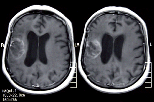 Figure 2. A heterogenous contrast-enhancing lesion at the postcontrast axial T1-weighted magnetic resonance image.