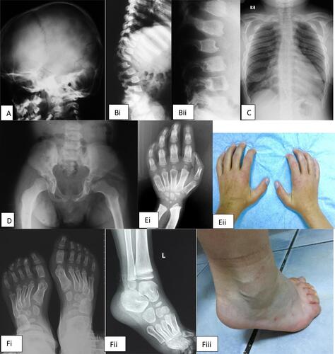 Figure 1 Radiological abnormalities seen in our patients with MPS type II. (A) Macrocephaly in 6 years old MPS II patient; (B) i,ii. Dorsolumbar kyphosis and a hypoplastic transitional vertebra with anterior beaking; (C) Short, thick clavicles, paddle-shaped ribs, scoliosis; (D) Round and flared iliac wings, an underdeveloped acetabulum and signs of hip dysplasia; (E) i,ii. Thick and hypoplastic distal radius and ulna creating a V-shaped deformity (Madelung deformity); small/underdeveloped carpal bones; bullet-shaped phalanges; (F) i,ii,iii. Small and hypoplastic tarsal bones and calcaneovalgus deformity.