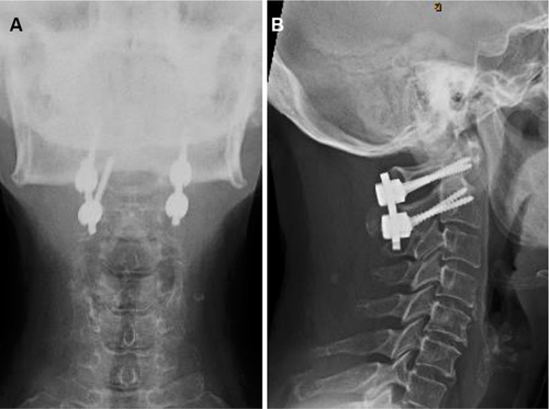 Figure 5 Anteroposterior (A) and lateral (B) views of the cervical spine showing posterior C1ߝC2 instrumentation with restored normal atlanto-dens interval.