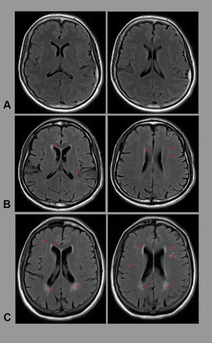 Figure 1 Examples of different severity of white matter lesions in study subjects. (A) None (65 year old European American female). (B) Thought present (66 year old African American male). (C) Pronounced (70 year old European American female).