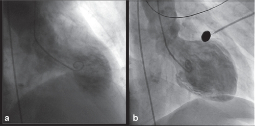 Figure 4 (a) This image is a left ventriculogram obtained during systole in the first patient. Hypercontractility of the basal segment and akinesis of the apical segment create the apical ballooning effect. (b) The ventriculogram obtained in the second case also demonstrates apical ballooning.