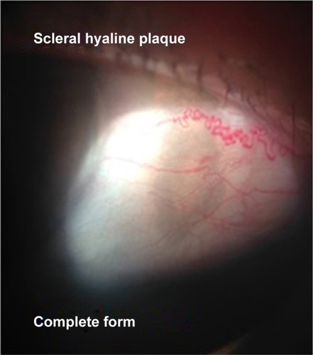 Figure 1 Biomicroscopy of anterior segment. Scleral hyaline plaque – Complete form.