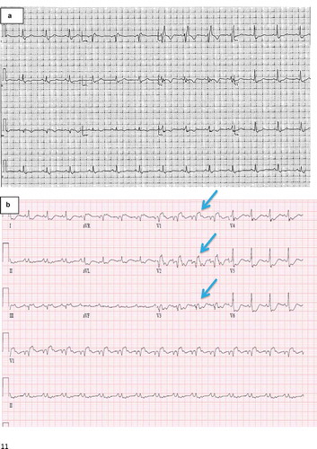Figure 1. Electrocardiograms