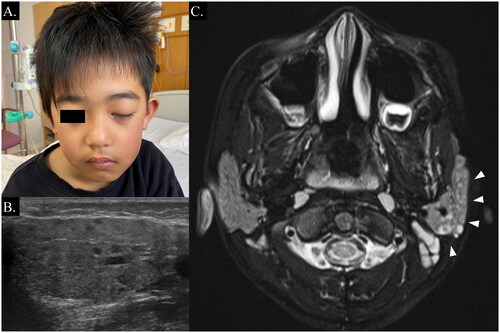 Figure 1. Clinical images of the case. (a) Image of the patient’s face on admission showing left parotid gland swelling and incomplete closure of the left eye. (b). Ultrasonographic images of the left parotid gland showing multiple hypoechoic lesions. (c) T2-weighted MRI showing multiple hyperintense lesions in the left parotid gland (white arrowheads).