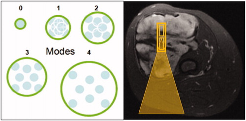 Figure 2. (A) The schematic on the left demonstrates the orientation of sub-sonications during a nominal sonication, with sub-sonications centered around a single point perpendicular to the direction of the sound beam, at varying degrees of spacing (0: least spacing, 4: most spacing). (B) In contrast, the axial T2-fat saturated image on the right demonstrates stacking of multiple sub-sonications (small yellow rectangles) along the direction of the beam path, which is used for elongated sonications. Beam path trajectory showed by the yellow triangle.