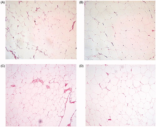 Figure 1. Representative hematoxylin and eosin staining of biopsies from (A) control and (B) patient; cancer-induced lymphedema in left leg. Biopsies from (C) control and (D) patient; cancer-induced lymphedema in right arm.