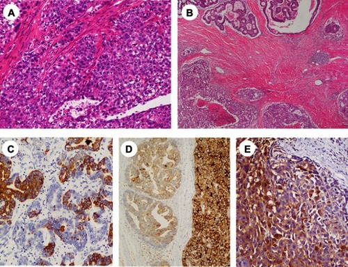 Figure 2 (A) Poorly differentiated CRC composed of hepatoid type (HE, original magnification×200). (B) Types of histological transitions in AFP-producing CRC, transition from COM (right side) to HPT (left side) (HE, original magnification×40). (C–E) Immunohistochemical staining: (C) Hepa-1; (D) GPC-3; (E) Arg-1. (immunohistochemistry, original magnification×200).Abbreviations: COM, common adenocarcinoma type; CRC, colorectal cancer; HPT, hepatoid type.