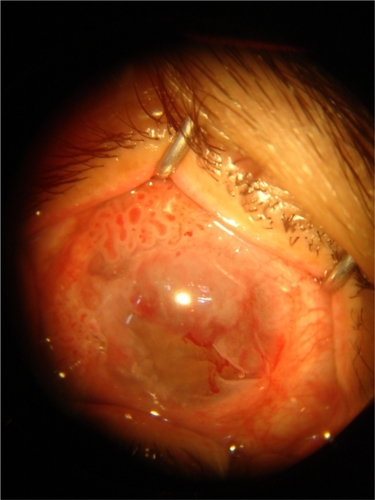 Figure 1A Extensive carcinoma in-situ at the time of presentation, involving most of the bulbar conjuctiva, imparting a gelatinous appearance to the conjunctiva and camouflaging the conjuctival vessels.