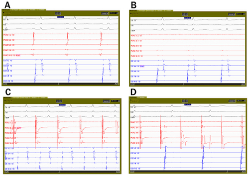 Figure 1 Pulmonary vein ablation catheter electrograms from the left inferior pulmonary vein.