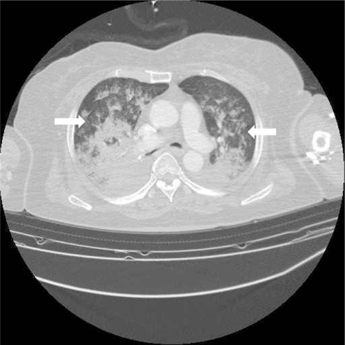 Figure 2 Chest computed tomography scan at the first postoperative day revealed interlobular septal wall thickening and patchy ground glass opacity in the bilateral upper lungs, consistent with NPPE (white arrows).