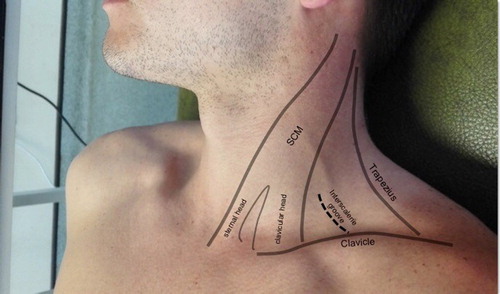 Figure 3: Photograph showing the posterior triangle of the neck. The clavicular head of the sternocleidomastoid (SCM) and clavicle forms the main landmarks for palpating the interscalene groove between the anterior and middle scalene muscles.