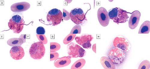 Figure 2. Heterophil projections in blood films of an injured gopher tortoise during 2.5 months of treatment (A-E; G). The projections are visible in mature (round nucleus and low nuclear to cytoplasmic ratio) and in immature heterophils (oval or elongated nucleus, larger nucleus compared to mature stage, immature granules, larger cell size). Mild toxicity is visible as mild degranulation, cytoplasmic basophilia, and/or vacuolation. A-B, E: mature heterophils, mild degranulation, and slight cytoplasmic basophilia; C-D, F-G: immature heterophils, mild degranulation, and slight cytoplasmic basophilia; H upper cell: mature heterophil; H bottom cell: immature heterophil, mild degranulation, cytoplasmic basophilia, and vacuolation. ×100 objective. Wright-Giemsa stain.