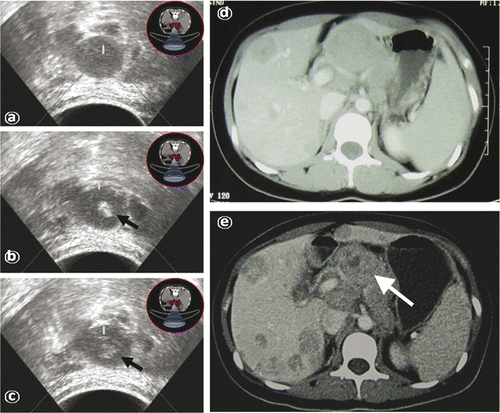Figure 2. Gray-scale changes of HIFU obtained on real-time ultrasound (US) images during HIFU procedure. (a) US image obtained before HIFU shows a large pancreatic carcinoma lesion present in the body of the pancreas. (b) US images obtained during the HIFU procedure show hyperechogenicity in the treated tumour (arrows). (c) US images obtained immediately after the one-slice HIFU procedure show the hyperechogenicity of treated tumour in the one slice lesion (arrows). (d, e) Transverse contrast-enhanced conventional CT scans obtained before (d) and 1 month after (e) HIFU ablation. There was an obvious regression (arrows) in lesion size of primary tumour after HIFU despite the progress of the liver metastases. All five images are taken from the same patient.