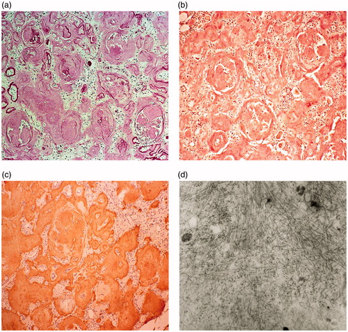 Figure 1. Renal biopsy findings (a) amorphous material is deposited in almost all of the glomeruli, small arteries and tubules (periodic acid-Schiff stain); (b) the amorphous deposits are positive for amyloid by Congo red staining; (c) immunohistochemical staining is positive for AA; (d) electron microscopy shows randomly arranged fibrils measuring 8–12 nm in the amyloid deposits.