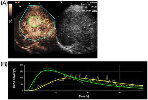 Figure 3. Contrast-enhanced ultrasound and time-intensity curves of hepatocellular carcinoma (HCC) and normal liver parenchyma. (a) Contrast-enhanced ultrasound image of the entire HCC (green line) and normal liver parenchyma (yellow line). (b) Time-intensity curves of the HCC (green line) and normal liver parenchyma (yellow line) obtained using the Sonoliver quantification software.